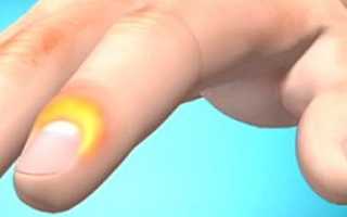 Панариций пальца на руке или ноге – лечение в домашних условиях