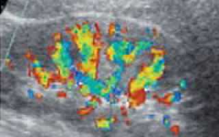 Причина смерти от хпн