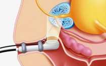 УЗИ урология. Диагностика узи почек.
