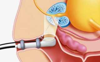 УЗИ урология. Диагностика узи почек.