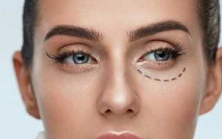 Устранение морщин. Безоперационная блефаропластика в Ульяновске