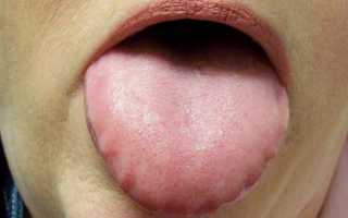 Все о причинах появления следов от зубов на языке и методах лечения