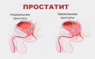 Китайский урологический пластырь zb Prostatic Navel Plasters для мужчин