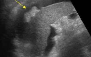 УЗИ брюшной полости. Показания, противопоказания, методика проведения. Подготовка к УЗИ брюшной полости