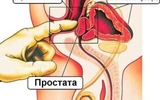 Урология массаж при простатите