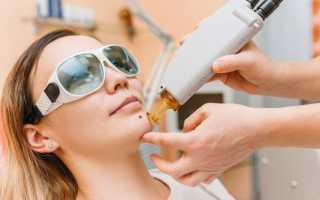 Удаление пигментации лазером, отзывы с фото до и после