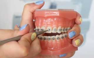 Брекеты Damon: сравнение Damon q, Damon 3, Damon 3MX и Damon clear