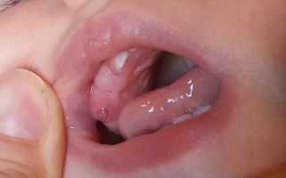 Что делать, если у ребенка появился свищ на десне?