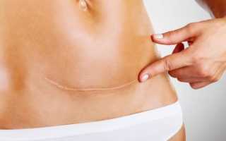 Операция маммопластика после родов: что нужно знать и ожидать женщине