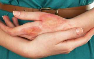 Сухие, шелушащиеся красные пятна на руках: причины появления