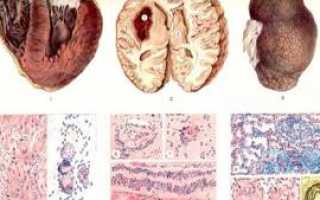 Диффузные изменения почек иногда обеих почек