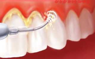 Стоматология Учебник Трезубова / Раздел 05 Культура врачебного приема. Психотерапия и анестезиологическая защита больных. Подготовка б / 03 Предварительное лечение перед протезированием