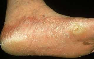 Шелушится кожа на ступнях ног — норма или патология?