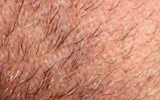 Диагностика и лечение гипертрихоза у мужчин и женщин