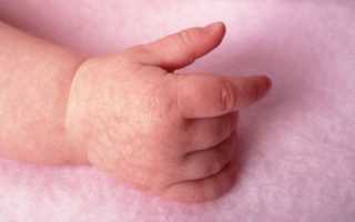 Болезнь или норма? В чем причины мраморной кожи у детей?