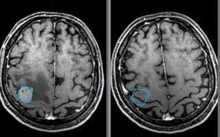 Киста головного мозга у новорожденного: диагностика, причины образования и лечение