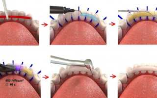 Протезирование при пародонтозе — какие протезы лучше?