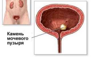 Камни в мочевом пузыре лечение народными средствами