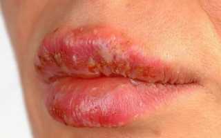 Язвочка на десне у ребенка — чем лечить и что делать маме?