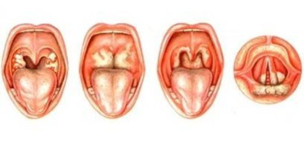 Абсцесс при ангине фото 4