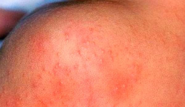 аллергический дерматит