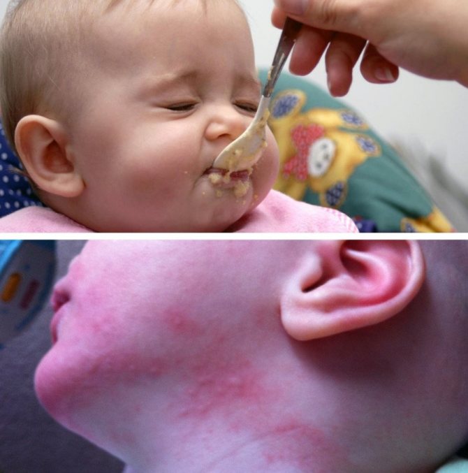 Аллергия на овсянку