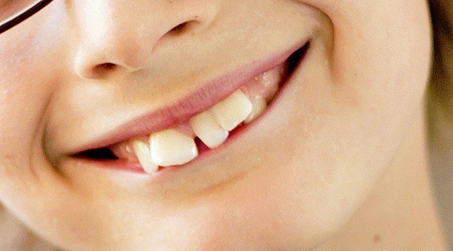 аномалии формы зубов