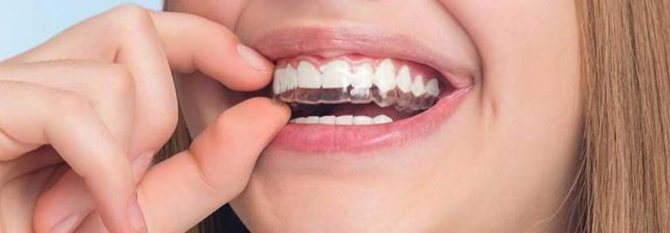 аномалии положения зубов