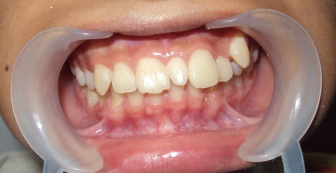 Аномалии зубов у взрослого