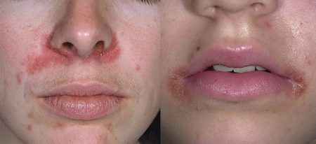 атопический дерматит на губах у ребенка