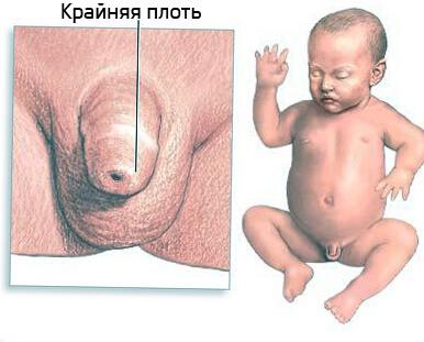 Баланит фото