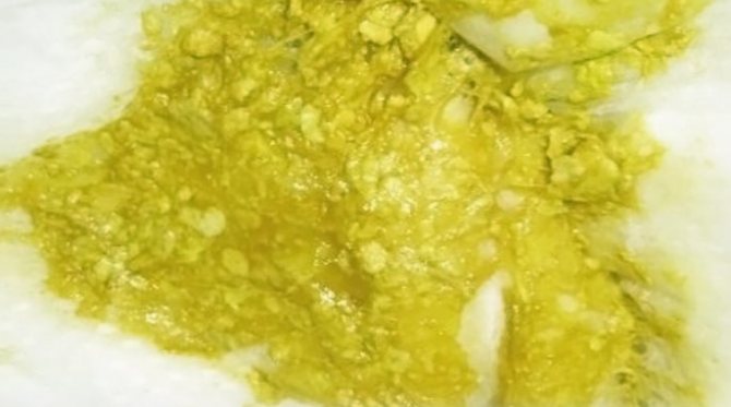 белые комочки в кале у грудничка