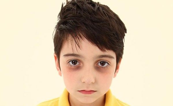 Болезненный мальчик с темными мешками под глазами