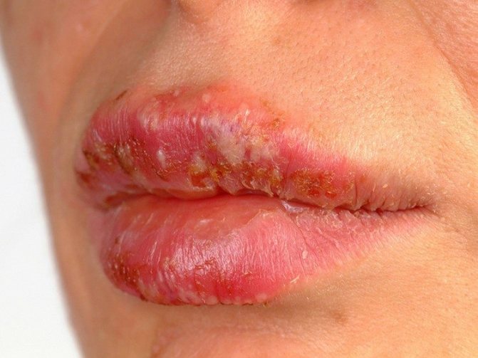 болячка на губе
