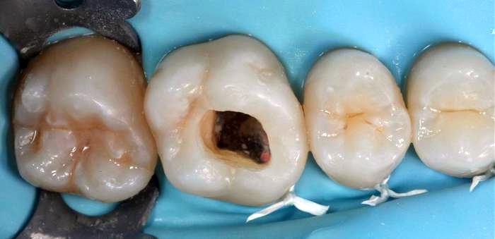 Что делать если выпала пломба