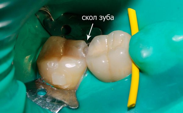 Что делать если выпала пломба