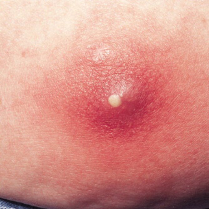 Что такое абсцесс