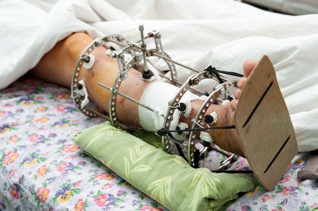 Для чего нужен аппарат илизарова