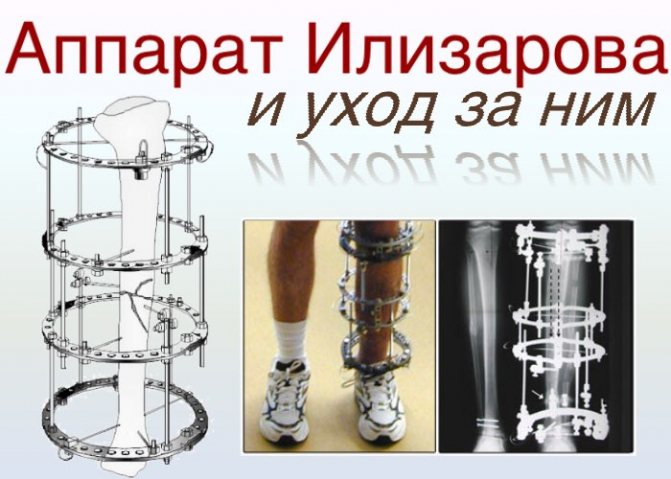 Для чего нужен аппарат илизарова