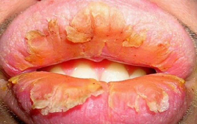 эксфолиативный хейлит (главный ключ)