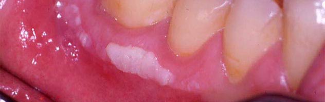 эрозивные поражения десен