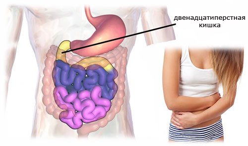 эрозивный дуоденит