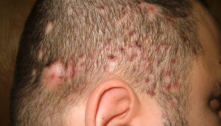 Фолликулит