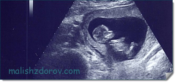 Фото ребенка на УЗИ