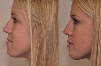 ФУНКЦИОНАЛЬНЫЕ НАРУШЕНИЯ ПРИ МЕЗИАЛЬНОМ ПРИКУСЕ