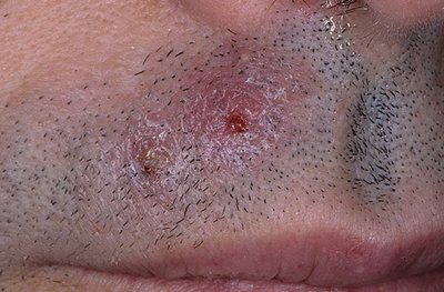 грибок кожи в области усов