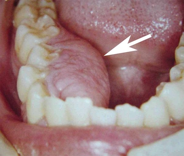 характеристика фиброзного эпулиса