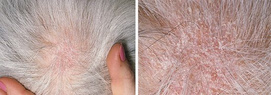 хроническое течение грибка кожи головы