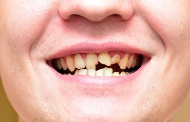 К чему видеть во сне потерю зуба