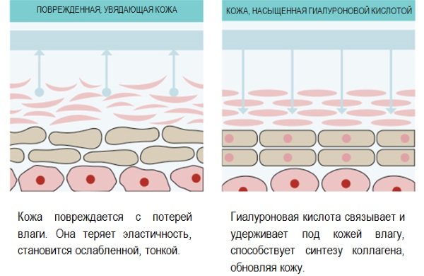 Как удалить комки Биша. Как убрать в домашних условиях, массаж, упражнения, диета, операция. Фото до и после